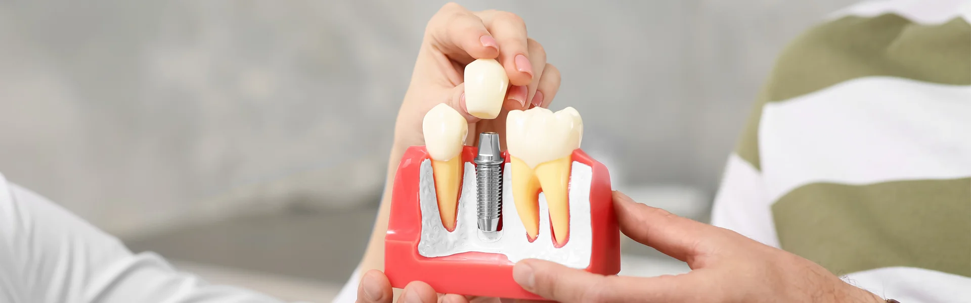 Why Dental Implants are the Ideal Solution for Missing Teeth in Burnaby